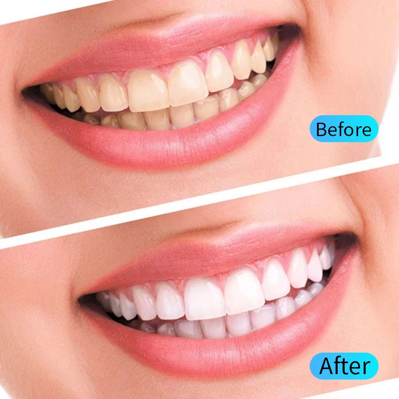 Teeth Whitening Gel Kits Dental Dentistry Bleach Tooth Oral Hygiene Care Dental Whitening Tool Remove Plaque Stains